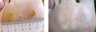 old-plantar-warts